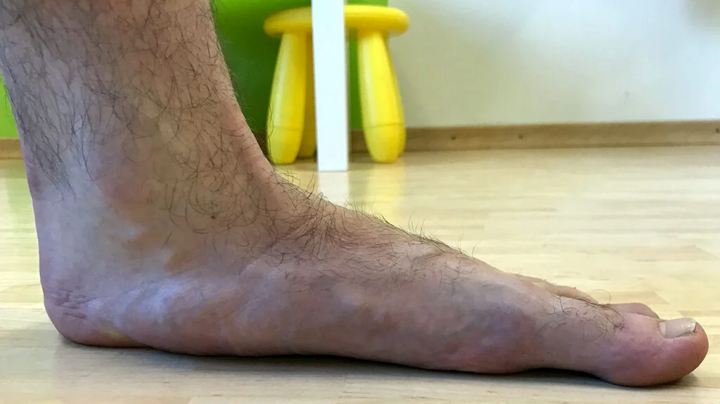 4 Flat Feet Left 1024x575 1