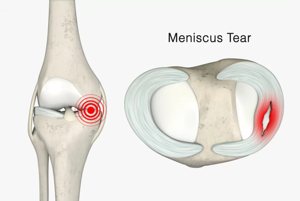 Meniscus Tear 3D Rendering Scaled Scaled 1