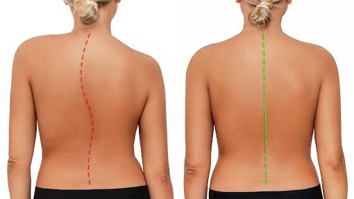 Scoliosis And Posture