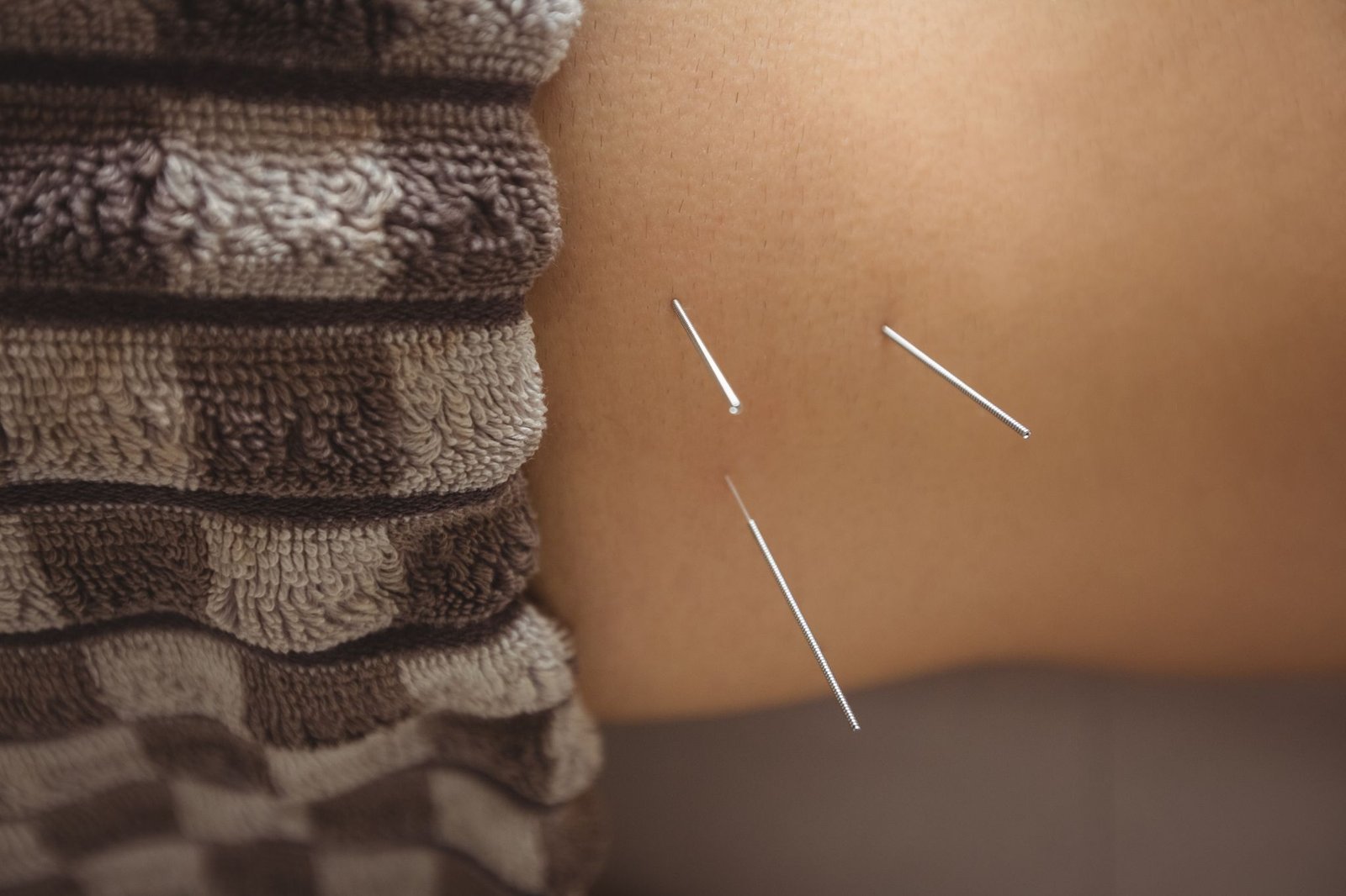 close up patient getting dry needling