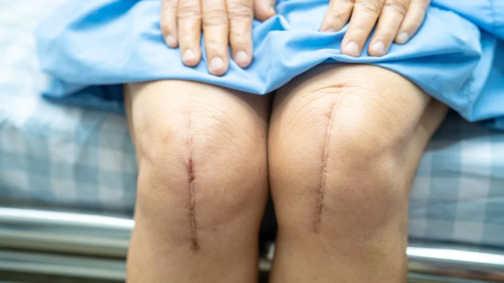 Recovery After Orthopedic Surgery Propel Physiotherapy