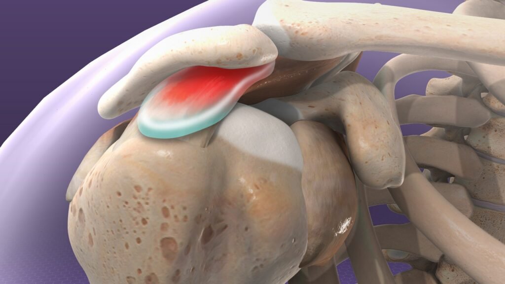 Shoulderimpingesyndrome 1280