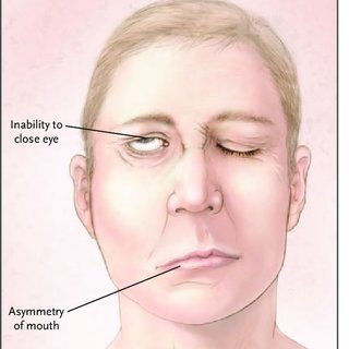 Bell's Palsy Rehabilitation A Patient With Bells Palsy Who Has Been Asked To Close His Eyes Typical Signs Include Q320