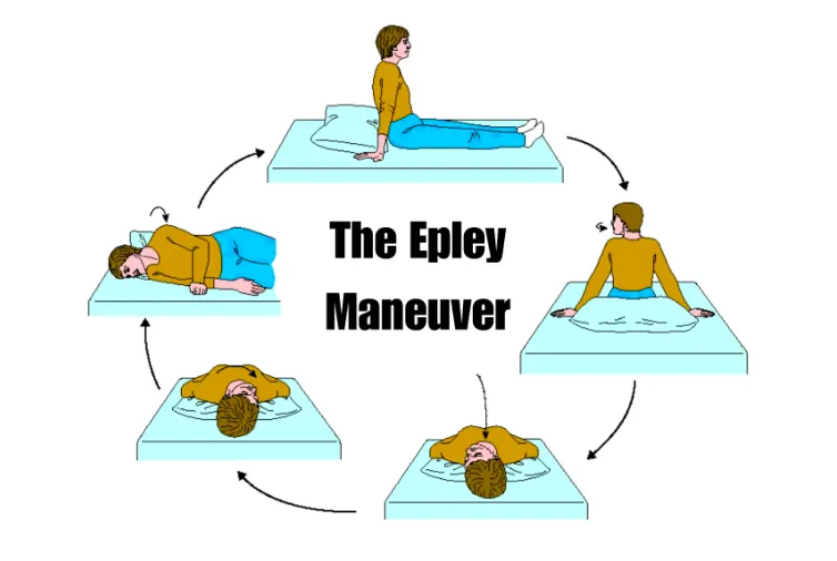 Vertigo Rehabilitation Epleys Maneuver